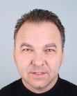 Before Hair Transplant &nbsp;Temporal Hairline
